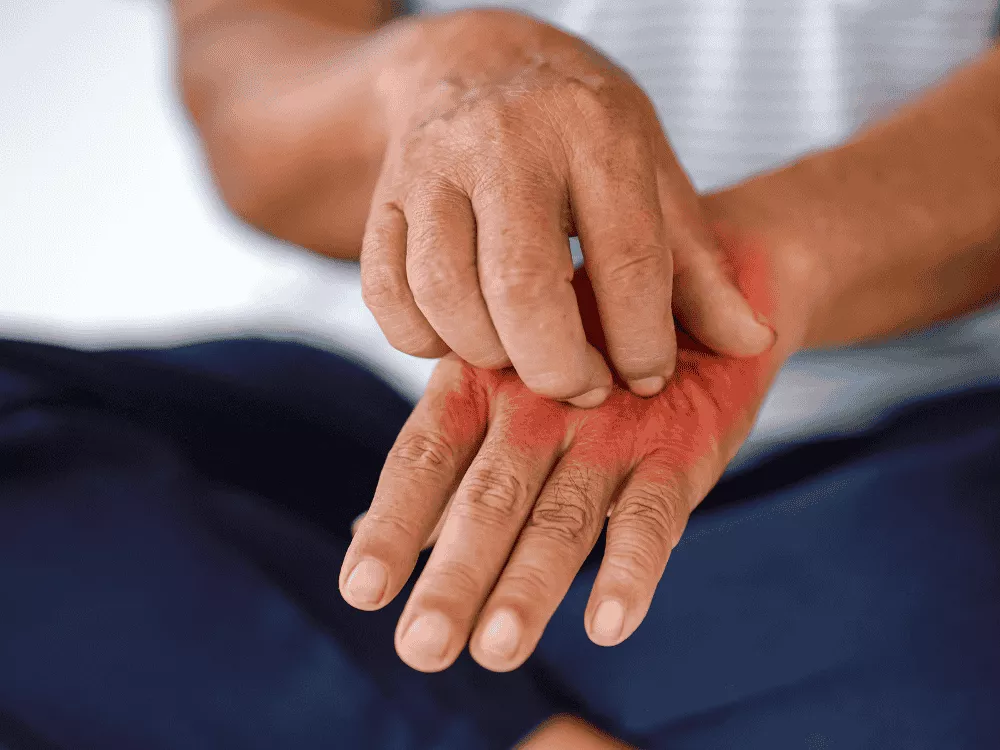 allergic-reactions-1000-x-750-px-6926b0a784355