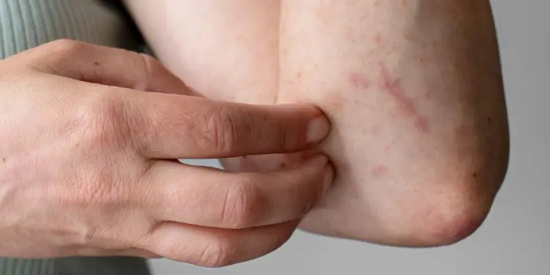 3 severe disease called dengue hemorrhagic fever or dengue shock syndrome