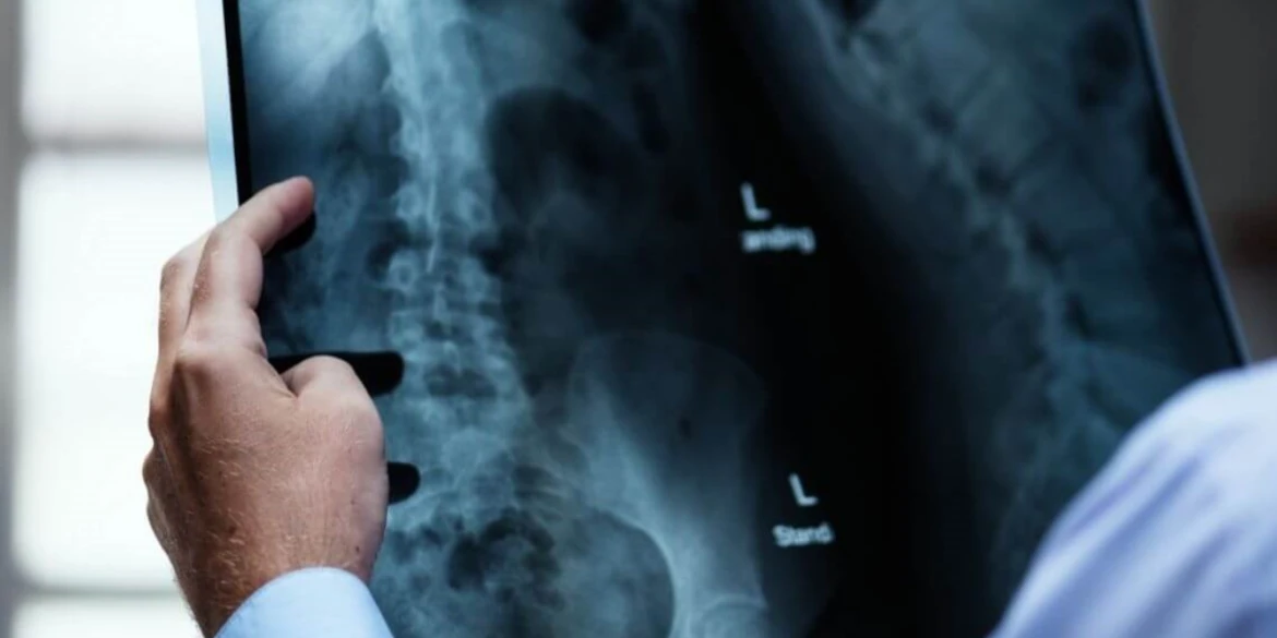 3 adolescent scoliosis diagnosed