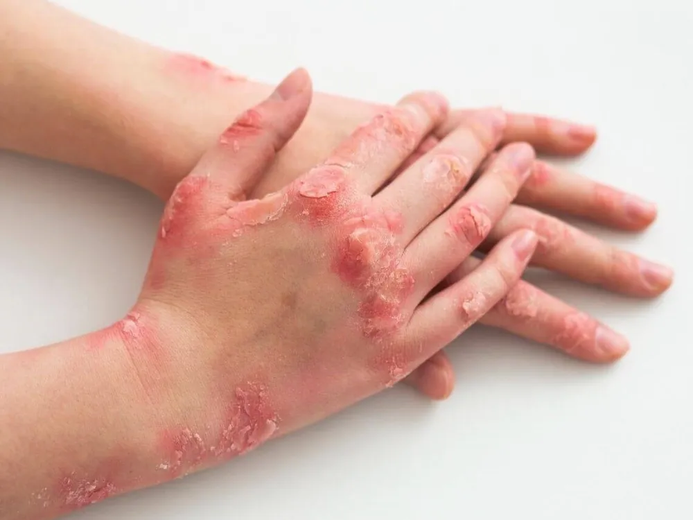 hfmd or hand, foot, and mouth disease contagious viral infection