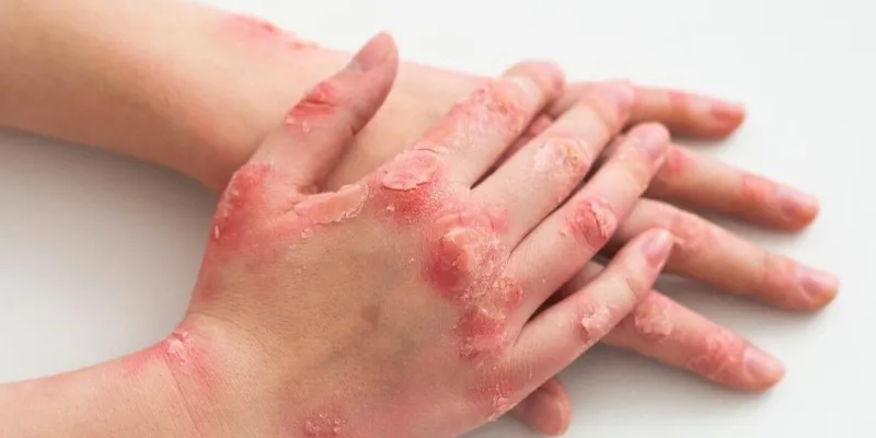 hfmd or hand, foot, and mouth disease contagious viral infection